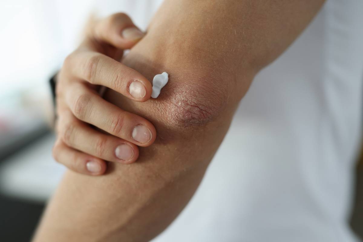 LM Natura : des soins dermatologiques naturels contre les problèmes de peau